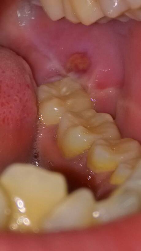 嘴巴内壁挨着牙齿的地方长泡